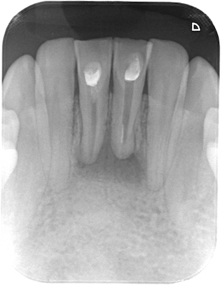 下顎前歯の根管治療　