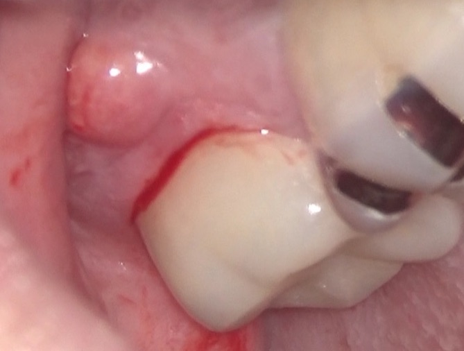 歯茎の腫れと深い歯周ポケット　原因は歯の内部の感染だった