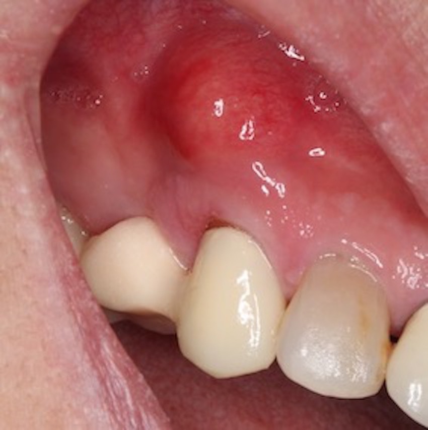 歯茎の腫れの原因は細菌感染