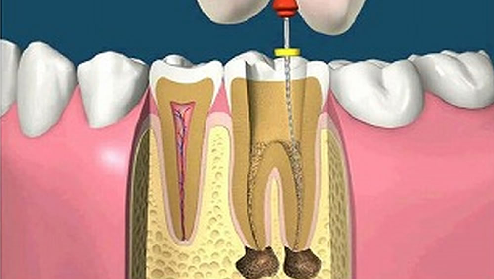 根管治療