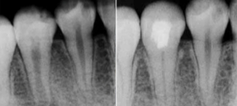 再生歯内療法